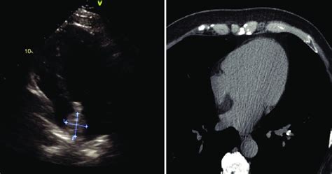 Lipomatous Hyper Trophy Of The Interatrial Septum At Transthoracic Download Scientific Diagram