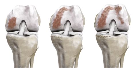 Massgeschneiderte Knieprothese Aus Dem 3D Drucker Hirslanden Blog