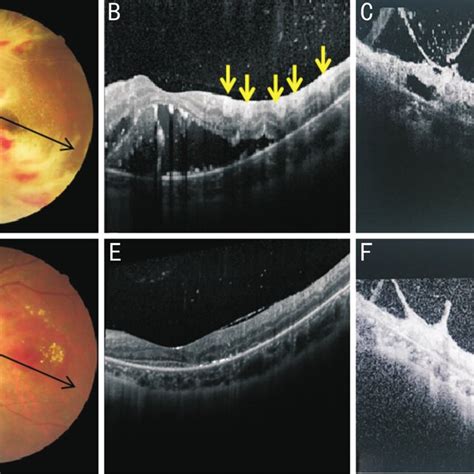 Fundus Photographs And Oct Images In Case Who Affected With Cmvr And