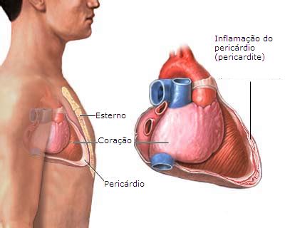 Clínica Cardiológica Flávio Cure Palheiro Pericardite