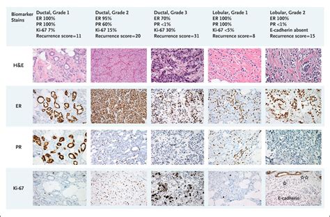 Systemic Therapy For Estrogen Receptorpositive Her2 Negative Breast