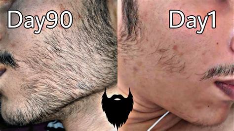 Minoxidil Beard Journey 3 Months Insane Results Youtube