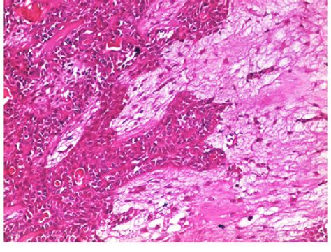 Pleomorphic Adenoma Presence Of Myoepithelial Cells Epithelial Cells