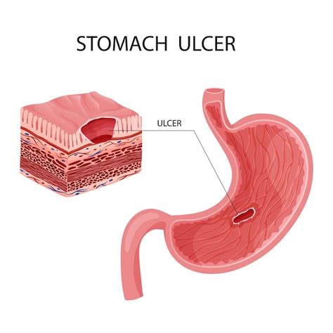 Premium Vector Peptic Ulcer In Stomach Detailed Vector Illustration