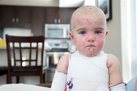 Epidermolysis Bullosa Eb Disease Paminaki Lovelly