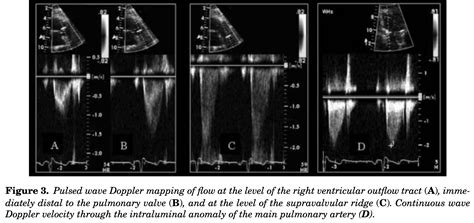 Pulmonary Stenosis Cardio Guide