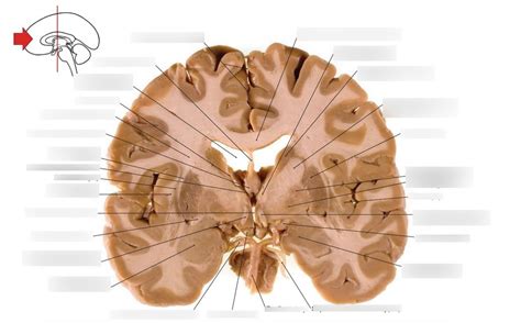 Fórnix Cerebro Coronal