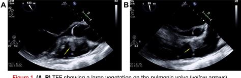 Figure 1 From Isolated Pulmonic Valve Endocarditis Case Report And Review Of Existing