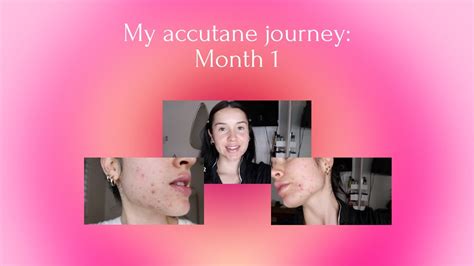 My Accutane Journey Round 2 Month 1 YouTube