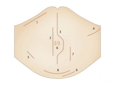 Abdominal Surgical Incisions