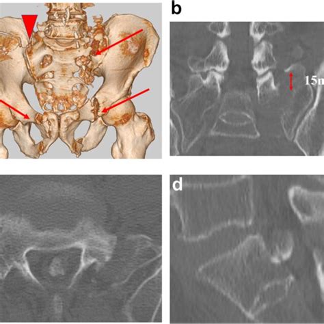 Preoperative Computed Tomography Scan A Arrows Indicate Fracture