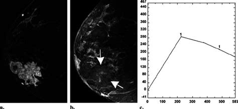 Moderately To Poorly Differentiated Palpable Mass Infiltrating Ductal Download Scientific