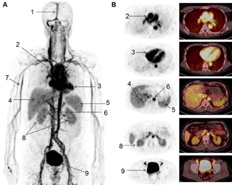 Figure 1 From Clinical Translation Of An Albumin Binding PET