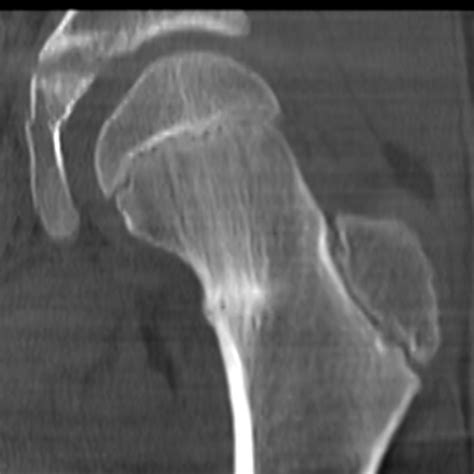 Femoral Stress Fracture Physiopedia