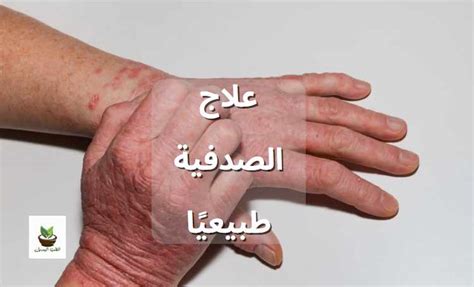 علاج الصدفية طبيعيًا الطب البديل