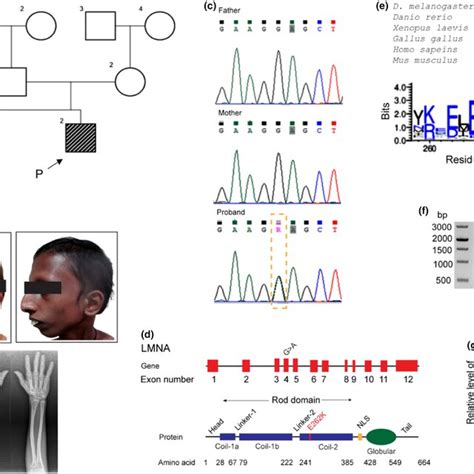 Whole Exome Sequencing Identified A C784ga Mutation In The Exon‐4 Of Download Scientific