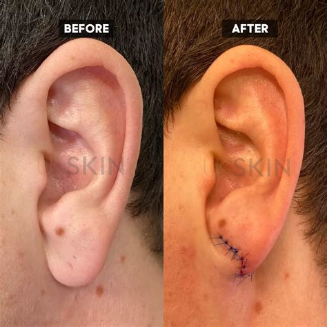 Expert Earlobe Repair From £495 Ukskin