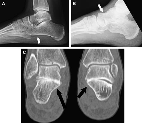 Imaging Of Tarsal Coalition Radiologic Clinics