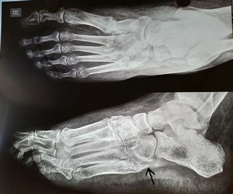 Charcot Foot With Osteomyelitis Diabetic Foot Clinic