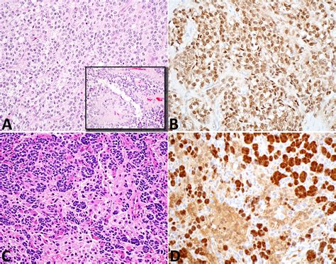 Clinicopathologic And Molecular Spectrum Of Testicular Sex Cord Stromal