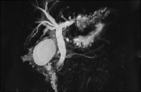 Magnetic Resonance Cholangiopancreatography Mrcp Illustrating Download Scientific Diagram