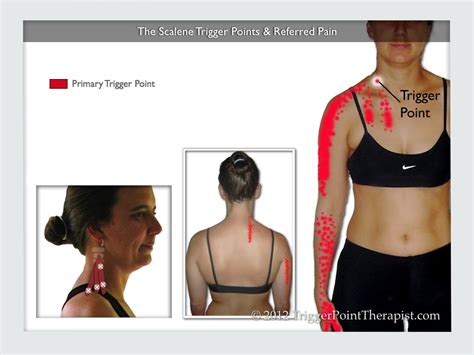 The Scalene Trigger Points: Upper Body Troublemakers ...