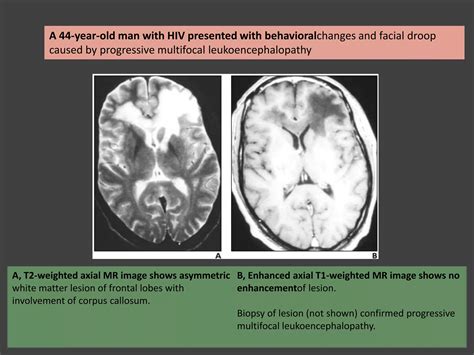 Disorders Of Corpus Callosum Ppt