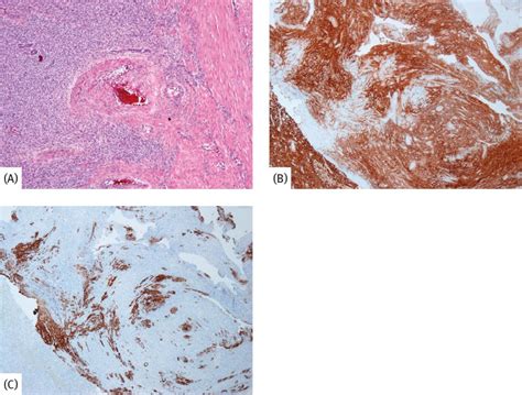 Low-grade endometrial stromal sarcoma | Musculoskeletal Key