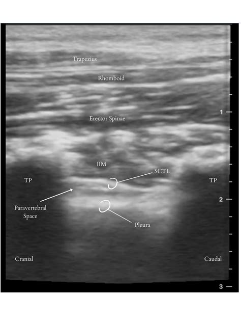 Paravertebral Block Ultrasound