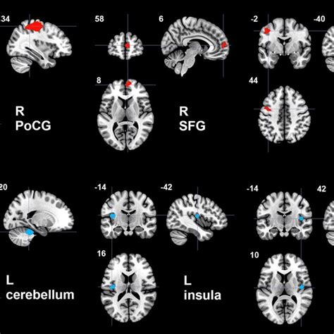 Regions Of Increased Red Color And Decreased Blue Color