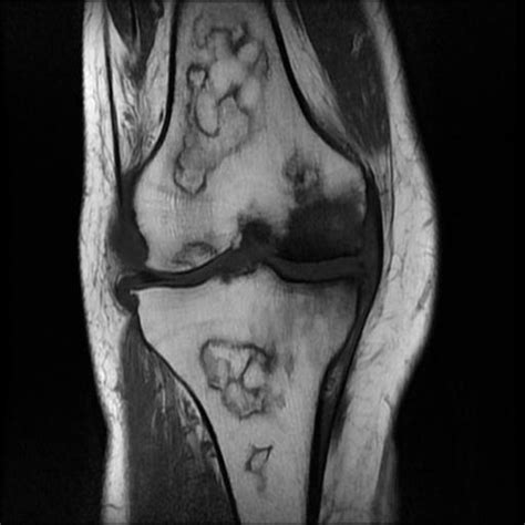 Multifocal Bone Infarcts Image