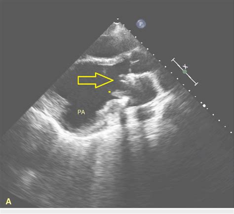 Two Dimensional Echocardiography Showing The Left Ventricular