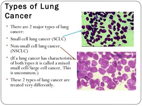 Non Small Cell Lung Cancer I