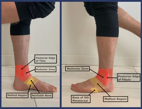 Sprained Ankle Vs Broken Ankle Rehab 49