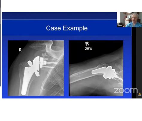 Reverse Shoulder Arthroplasty From Primary To Revision