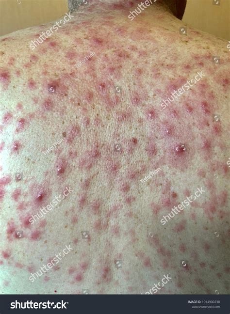 Multiple Well Define Erythematous Maculopapular Rash Foto Stok