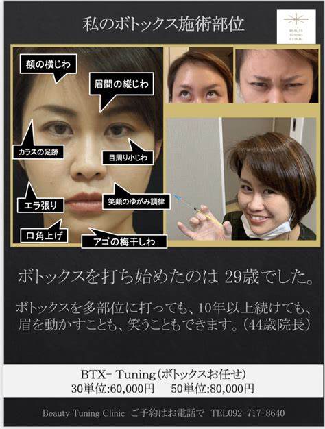 ボトックス止めといた方がいいんじゃない？というボトックスを打ったことないお友達だけでなく、16年打ち続けた私の話も聞いて欲しい 西田美穂の