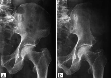 Case 7 A Giant Cell Tumor Of The Left Iliac Wing B After Wide Download Scientific Diagram