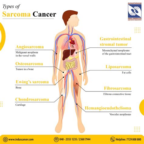 Understanding Sarcoma Cancers: A Comprehensive Guide - Induscancer