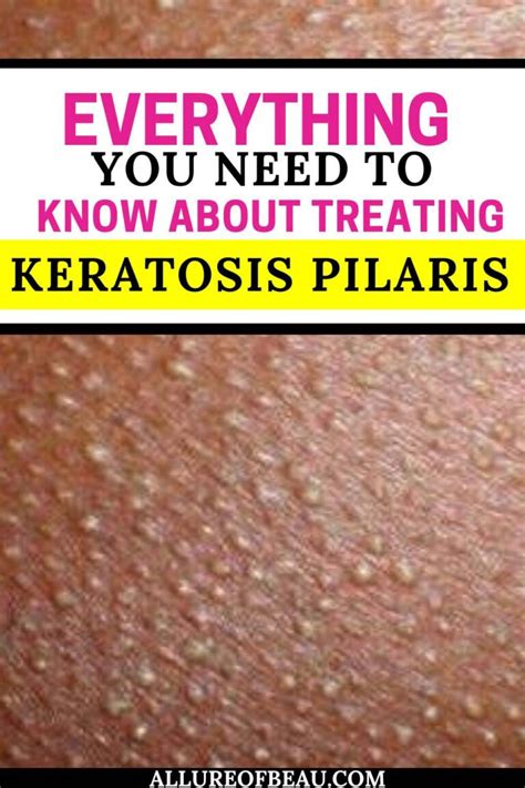 How To Get Rid Of Keratosis Pilaris Allure Of Beau