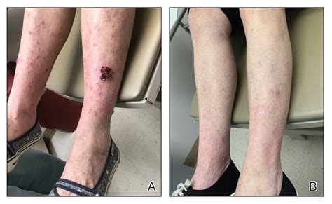 Topical Treatment For Actinic Keratoses And Skin Cancer Off