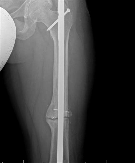 Femoral Shaft Fractures Trauma Orthobullets