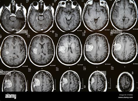 Mri meningioma hi-res stock photography and images - Alamy