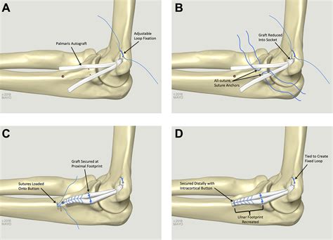 Reconstruction Of The Medial Ulnar Collateral Ligament Of The Elbow