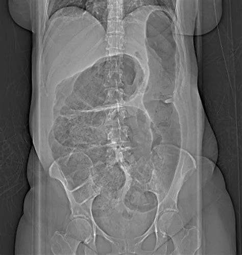 Volvulus Definition Causes Volvulus Types Diagnosis Volvulus Treatment