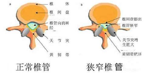 腰椎椎管狭窄症腰椎盘突出症分不清楚？掌握以下五点，轻松区分！ 知乎