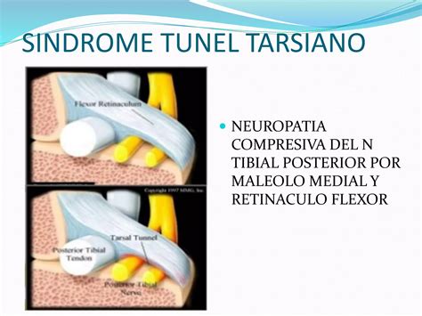 Sindrome Tunel Tarsiano Y Luxacion De Peroneos PPT Descarga Gratuita