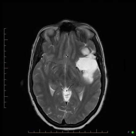 Intracranial Epidermoid Cyst Image Radiopaedia Org