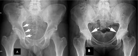 Protrusio Acetabuli A Normal Appearance The Ilioischial Line Is Shown