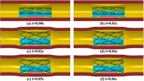 Different Stages Of Stent Expansion In Model E C A Beginning Of